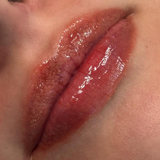 Hydra Lips - 5 Sessions Package